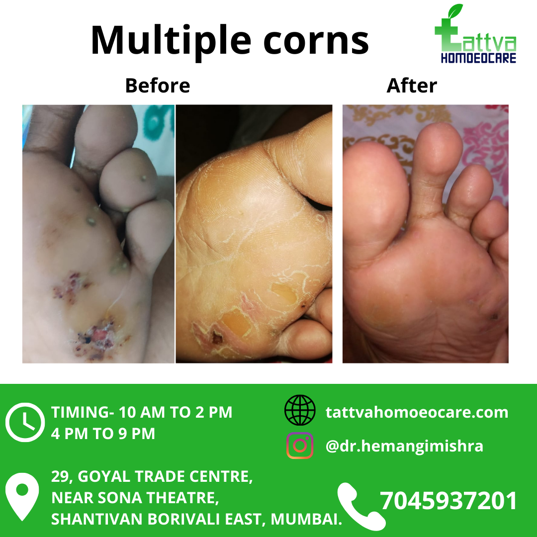 homeopathy treatment for painful corn