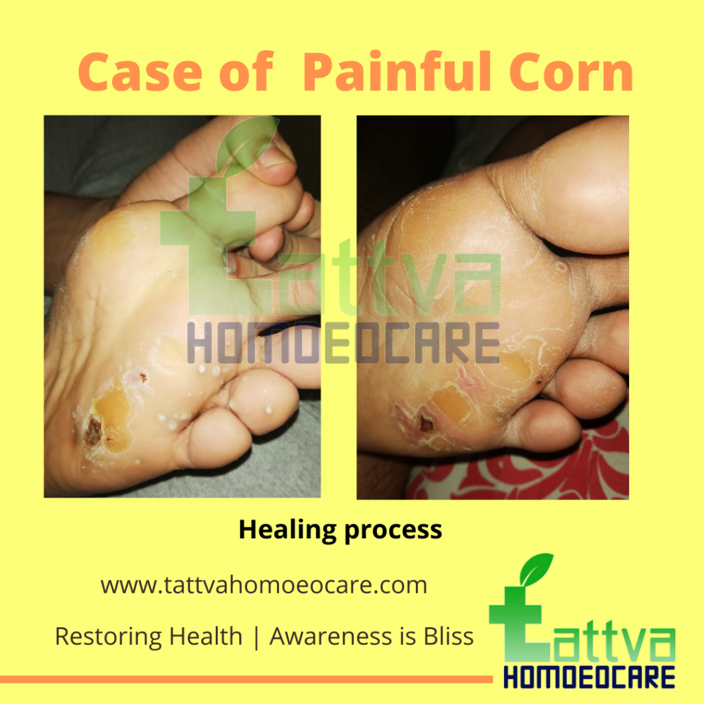Homeopathy treatment for painful corn