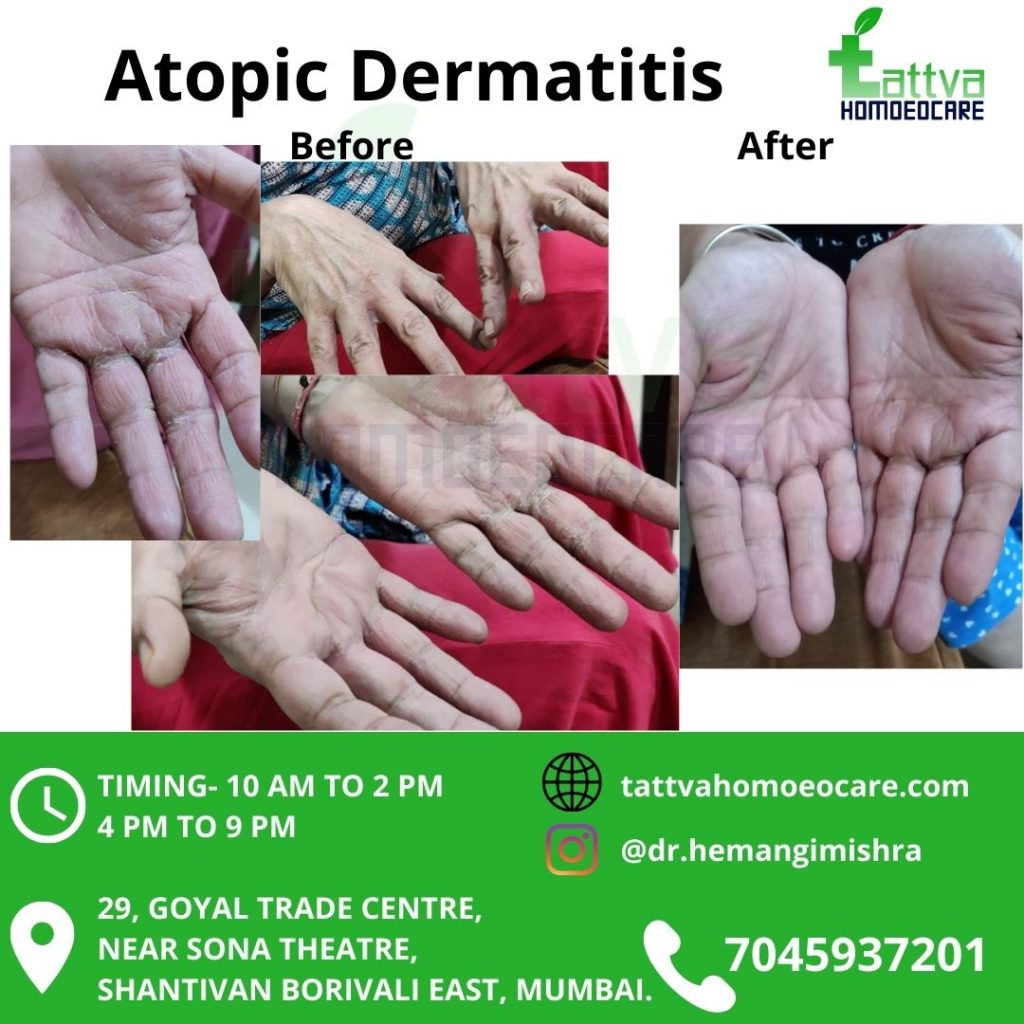 Atopic dermatitis and homeopathy- amazing result!