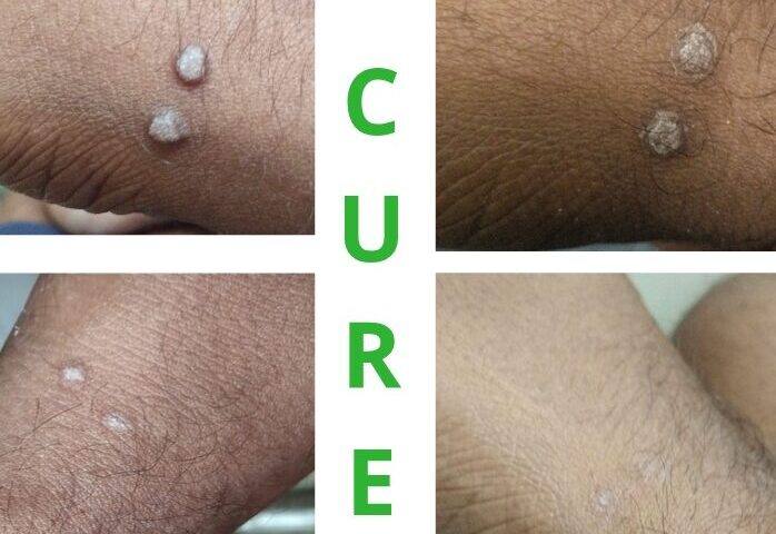 Viral wart