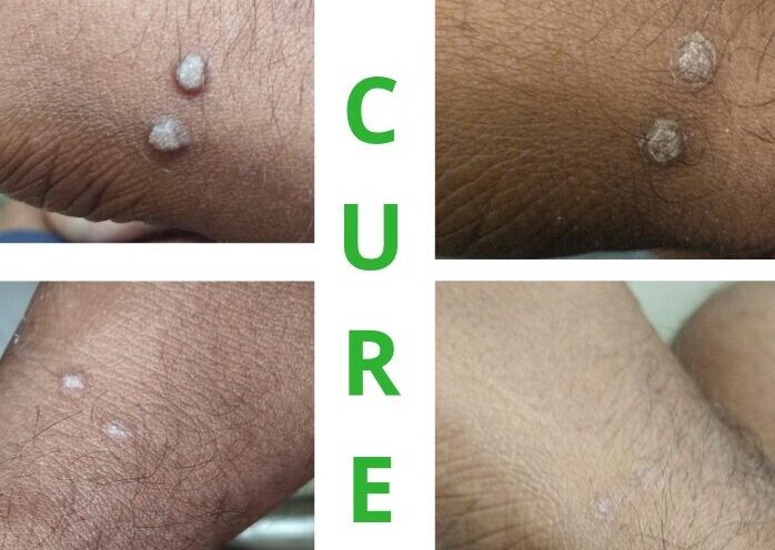 Viral wart