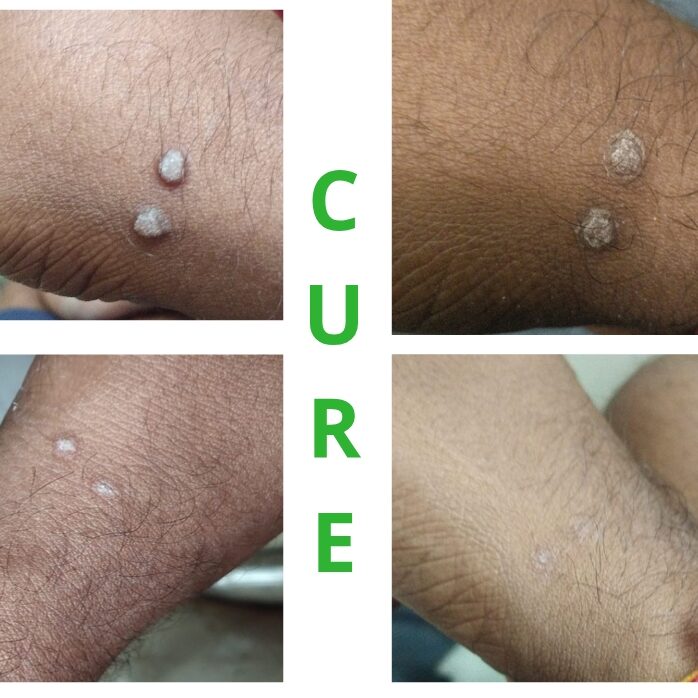 Viral wart
